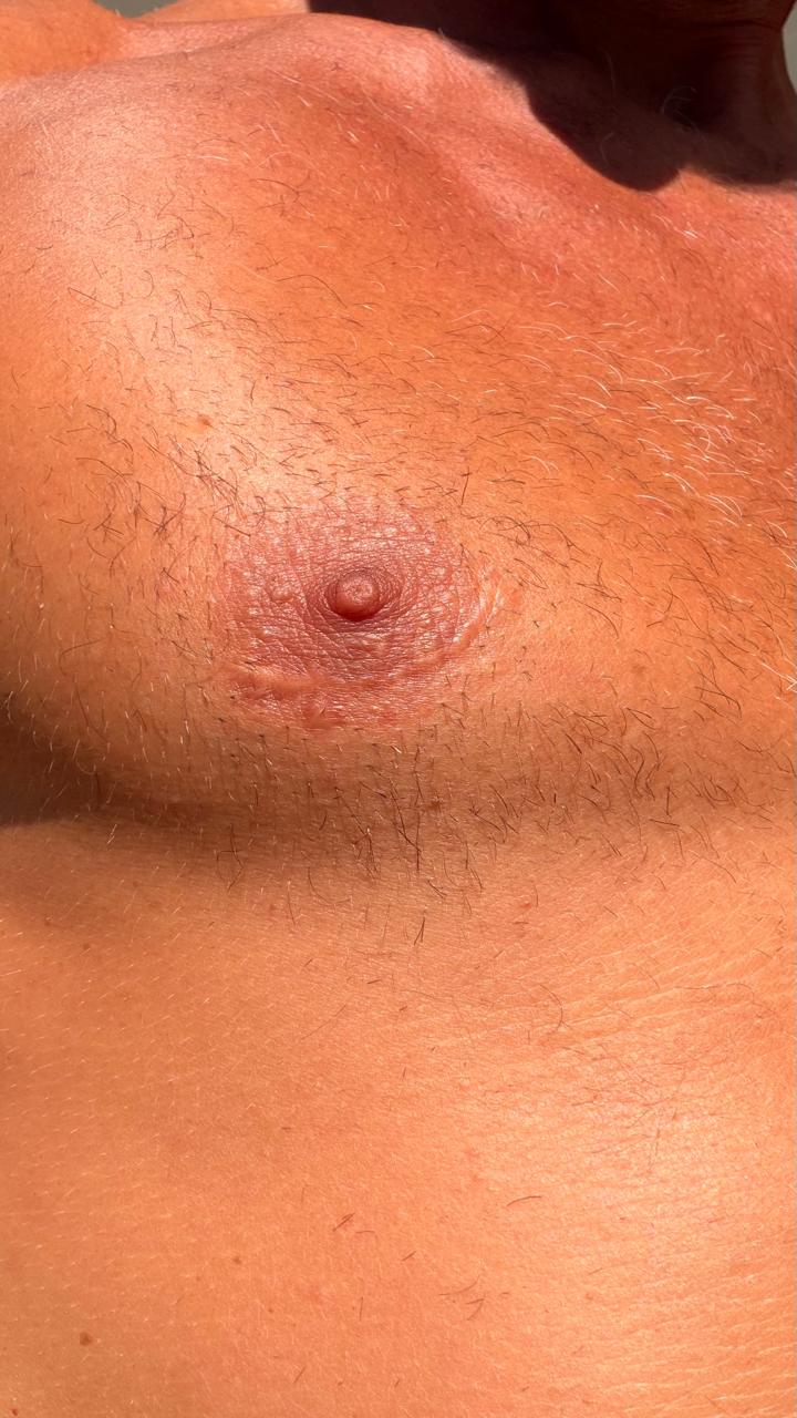 The scar on Sin's chest - a personal reminder of screening decisions